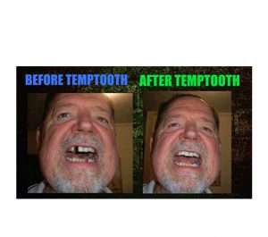 Temptooth #1 Seller Trusted Patented Temporary Tooth Replacement Product - with Free Dental Tools - Image 7